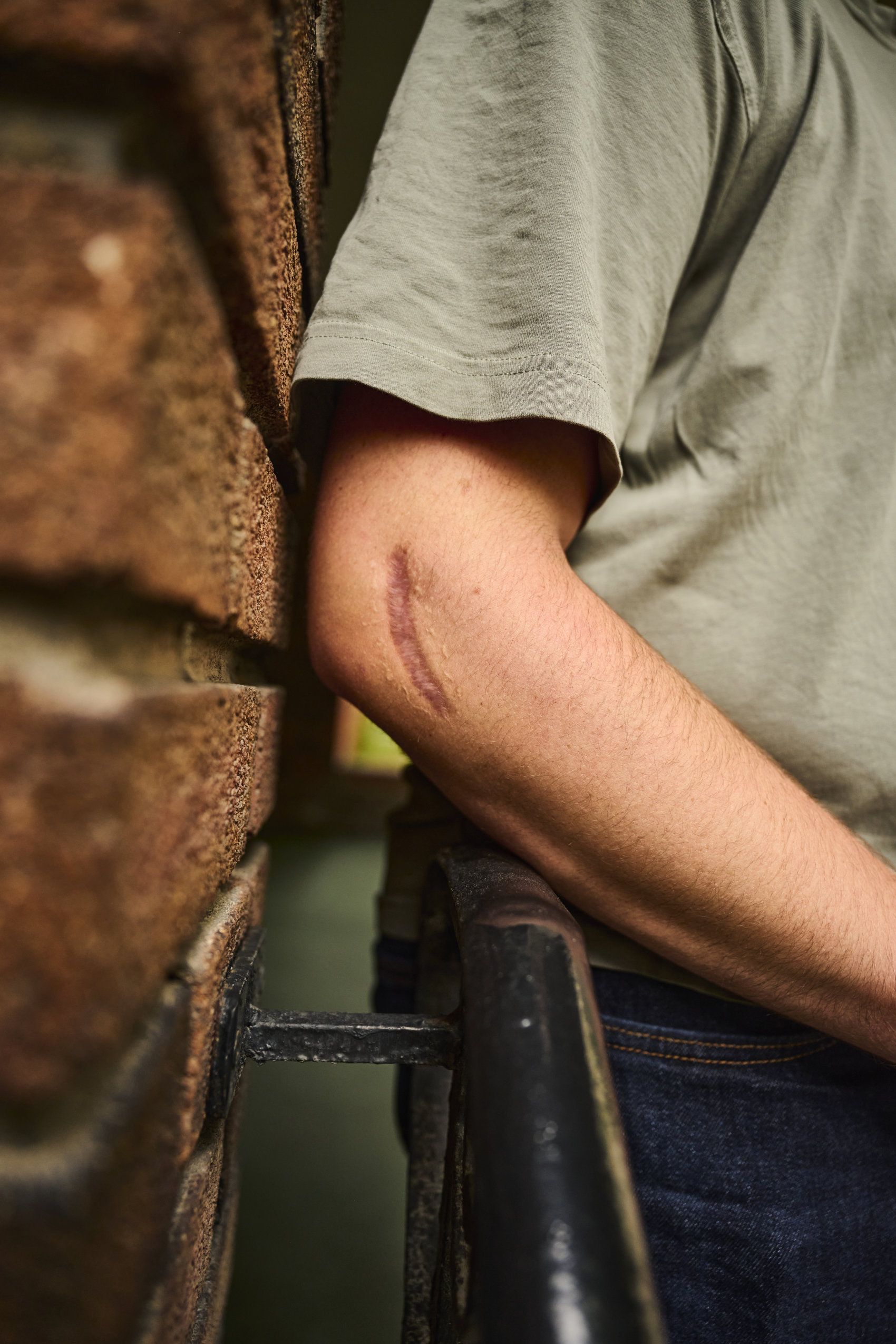 A close up image of a scar on a man's right elbow.